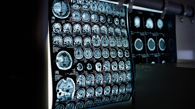 Una resonancia magnética muestra un cerebro humano
