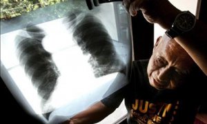 En la imagen, un hombre enfermo de cancer enseña la radiografía de sus pulmones. EFE