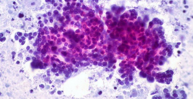 Una nueva quimioterapia puede alargar la vida en cáncer de páncreas más común