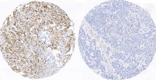 Investigadores españoles hallan el primer 'atlas' de proteínas para pronosticar el cáncer de mama más agresivo