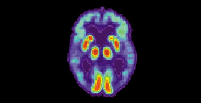 Un algoritmo detecta Alzheimer con seis años de anticipación