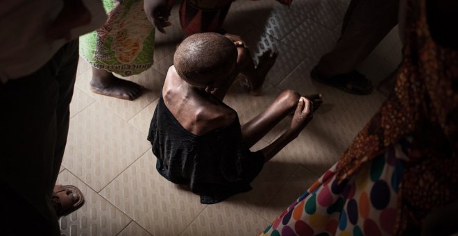 Más de 1,7 millones de niños están en riesgo de muerte por desnutrición grave en el Cuerno de África