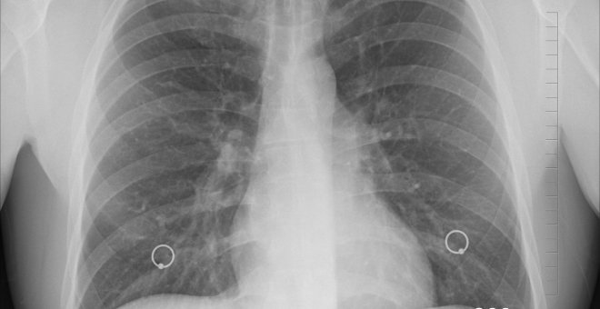 Investigadores descubren cómo frenar aún más el cáncer de pulmón