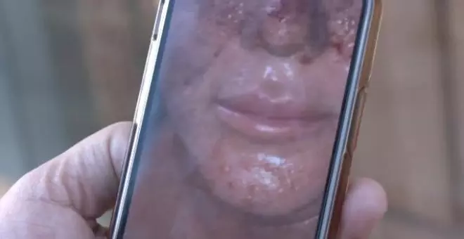 Andrea, víctima de la 'clínica del terror' de Marbella: "Hace nueve años me destrozó la cara"