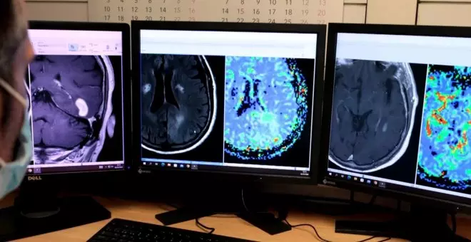 Milloren el diagnòstic de tumors cerebrals gràcies a una eina basada en la IA creada per investigadors catalans