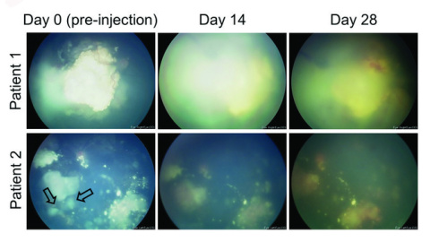 Evolución de los ojos de dos pacientes que recibieron la terapia / G. Pascual-Pasto et al., Science Translational Medicine