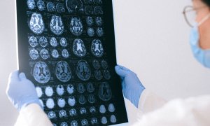 Procés de diagnosi de l’alzheimer