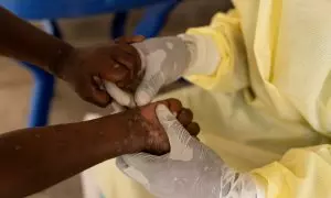 Un enfermero toma una muestra de un niño declarado caso sospechoso de mpox (antes viruela del mono) en un centro de tratamiento en  la provincia de Kivu del Norte, de la República Democrática del Congo. REUTERS/Arlette Bashizi