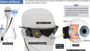 Los tres primeros implantados con un ojo biónico muestran importantes avances en su visión