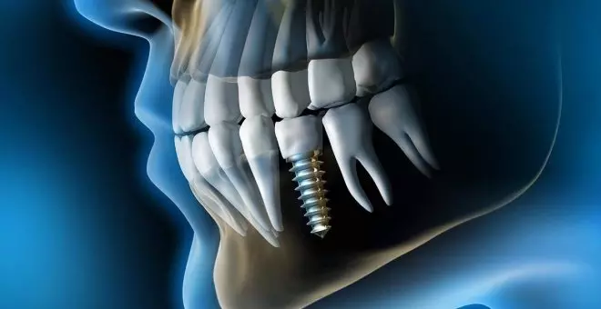 ¿Los implantes dentales realmente son duraderos?